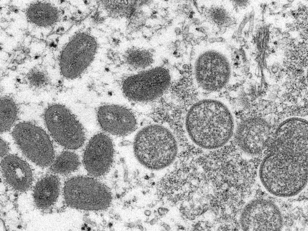 This 2003 electron microscope image made available by the Centers for Disease Control and Prevention shows mature, oval-shaped monkeypox virions, left, and spherical immature virions, right.