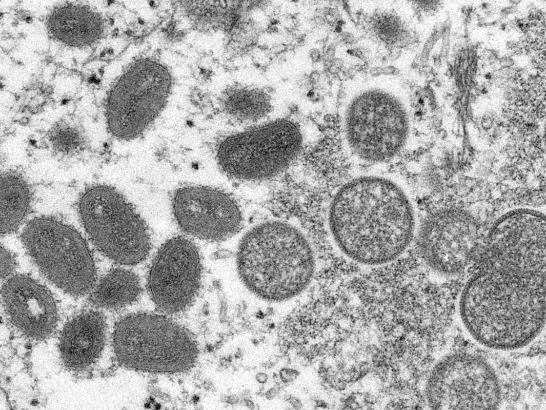 This 2003 electron microscope image made available by the CDC shows mature, oval-shaped monkeypox virions, left, and spherical immature virions, right, obtained from a sample of human skin associated with the 2003 prairie dog outbreak.