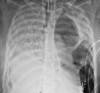 This X-ray image provided by Northwestern Medicine in June 2020 shows the chest of a COVID-19 patient before she received a new set of lungs because of severe lung damage from the coronavirus.