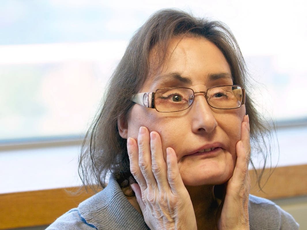 Connie Culp, the nation’s first partial face transplant recipient, speaks with the Associated Press at the Cleveland Clinic in Cleveland, Ohio.
