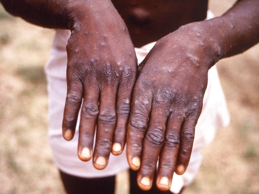 This Centers for Disease Control and Prevention image from an investigation into an outbreak of monkeypox in the Democratic Republic of Congo shows the hands of a monkeypox case patient displaying characteristic rash during its recuperative stage.  