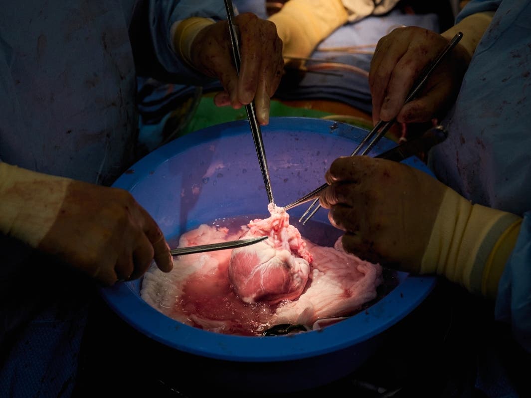 In this photo provided by NYU Langone Health, surgeons prepare a genetically modified pig heart for transplant into a recently deceased donor at NYU Langone Health on Wednesday, July 6, 2022, in New York.