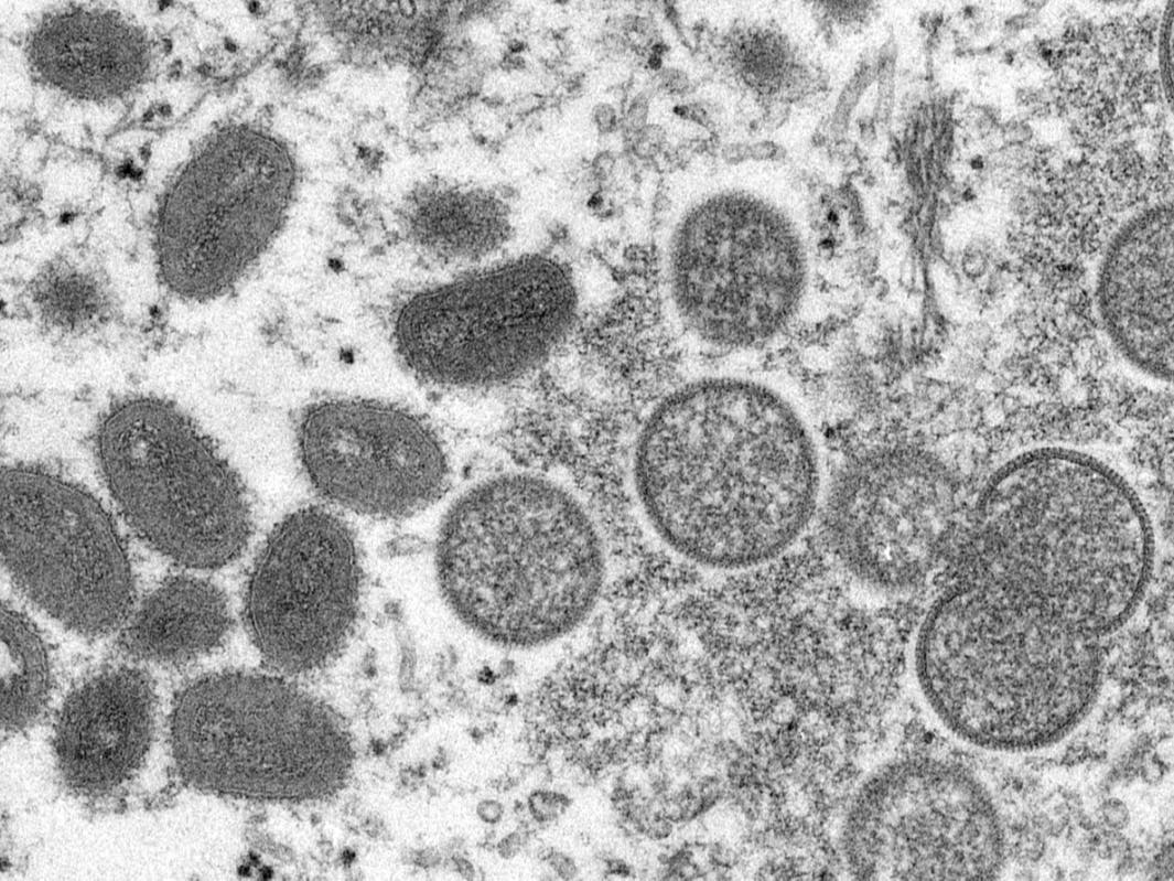 This 2003 electron microscope image made available by the Centers for Disease Control and Prevention shows mature, oval-shaped monkeypox virions, left, and spherical immature virions, right, obtained from a sample of human skin.