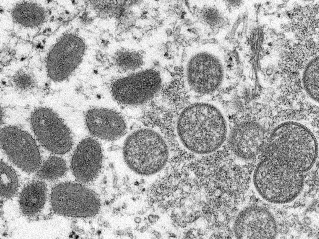 This 2003 electron microscope image made available by the Centers for Disease Control and Prevention shows mature, oval-shaped monkeypox virions, left, and spherical immature virions, right, obtained from a sample of human skin.