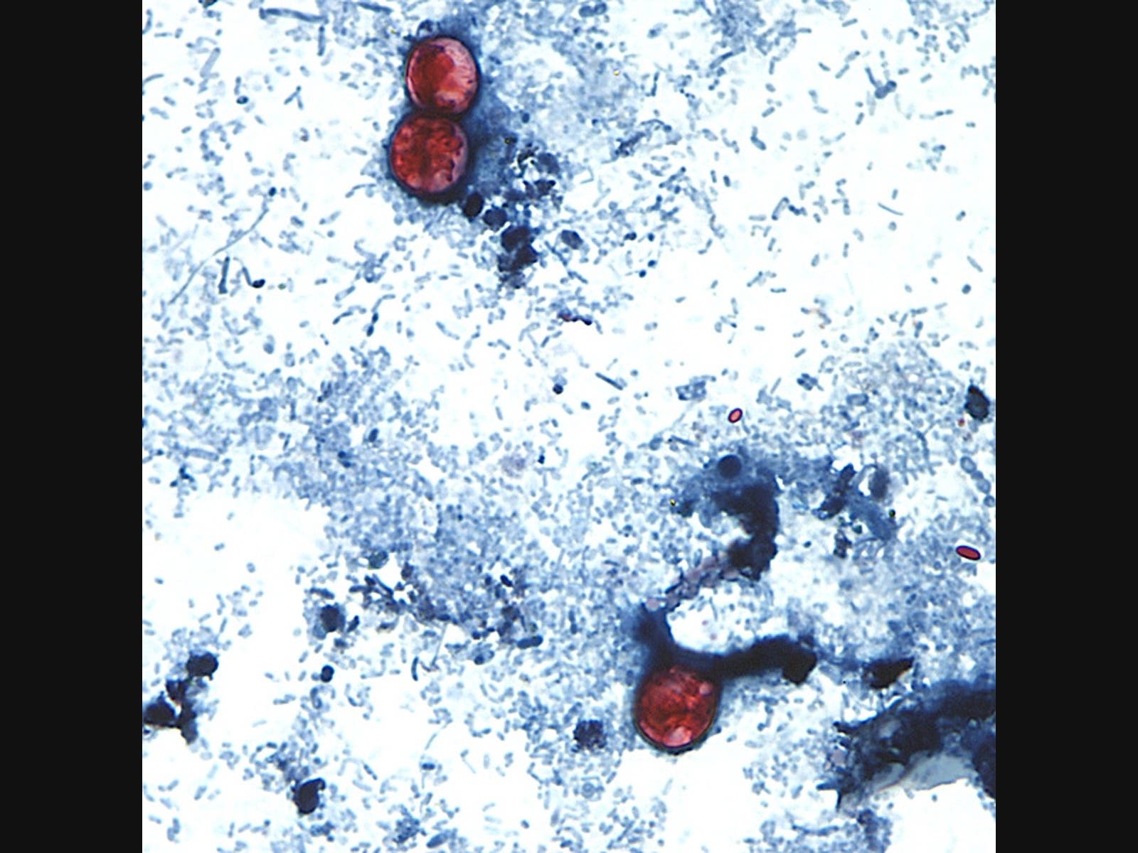 This undated photo taken through a microscope provided by the CDC shows Cyclospora cayetanensis oocysts found in a fresh stool sample which had been prepared with a formalin solution and stained with safranin.