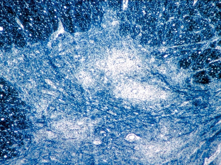 This 1964 microscope image made available by the U.S. Centers for Disease Control and Prevention shows damage from the polio virus to human spinal cord tissue. On July 21, New York health officials reported a polio case, the first in the US in a decade.