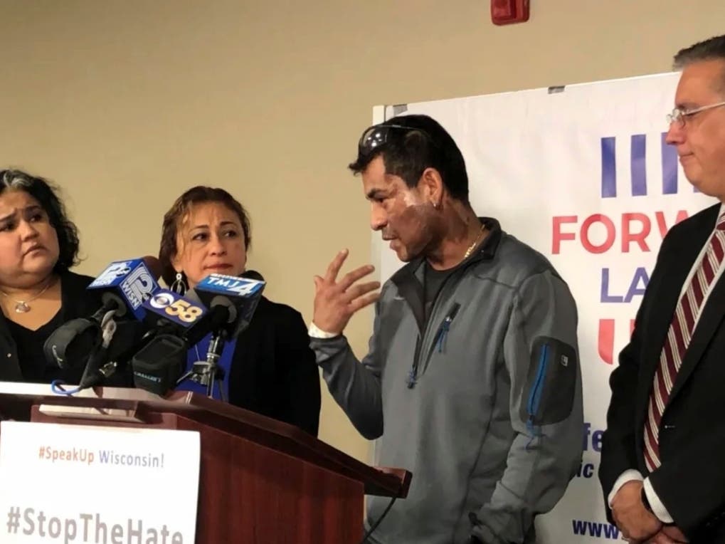 Mahud Villalaz, 42, of Milwaukee gestures to the second-degree burns on his face during a news conference.