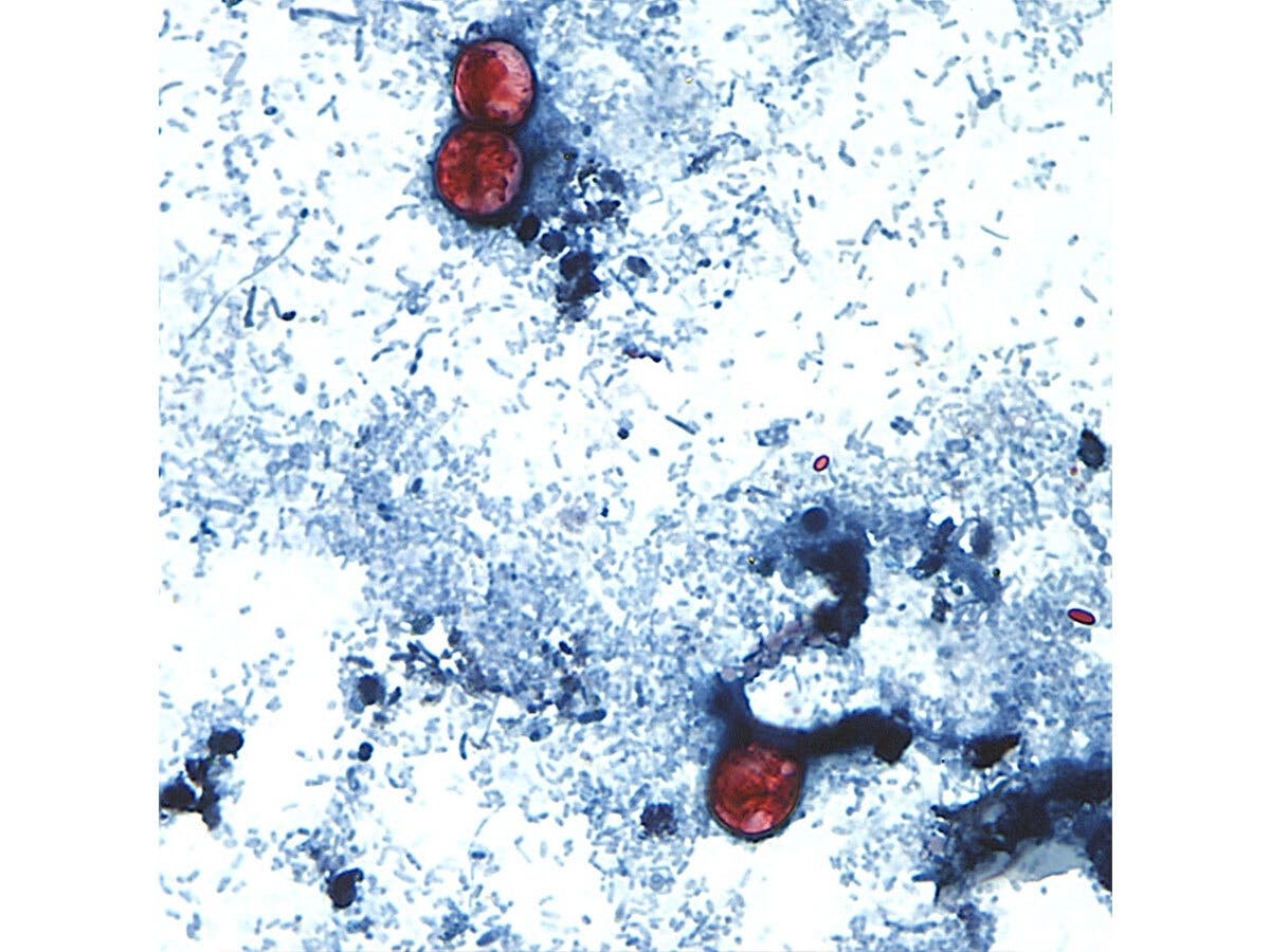 Cyclospora is a microscopic, spherical parasite that commonly causes watery diarrhea, including “explosive bowel movements,” according to the Centers for Disease Control and Prevention. The illness, called cyclosporiasis, is treatable with antibiotics.