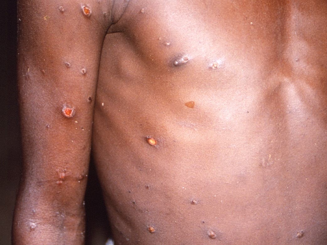 The right arm and torso of a patient show a number of lesions from what had been an active case of monkeypox in this file photo.
