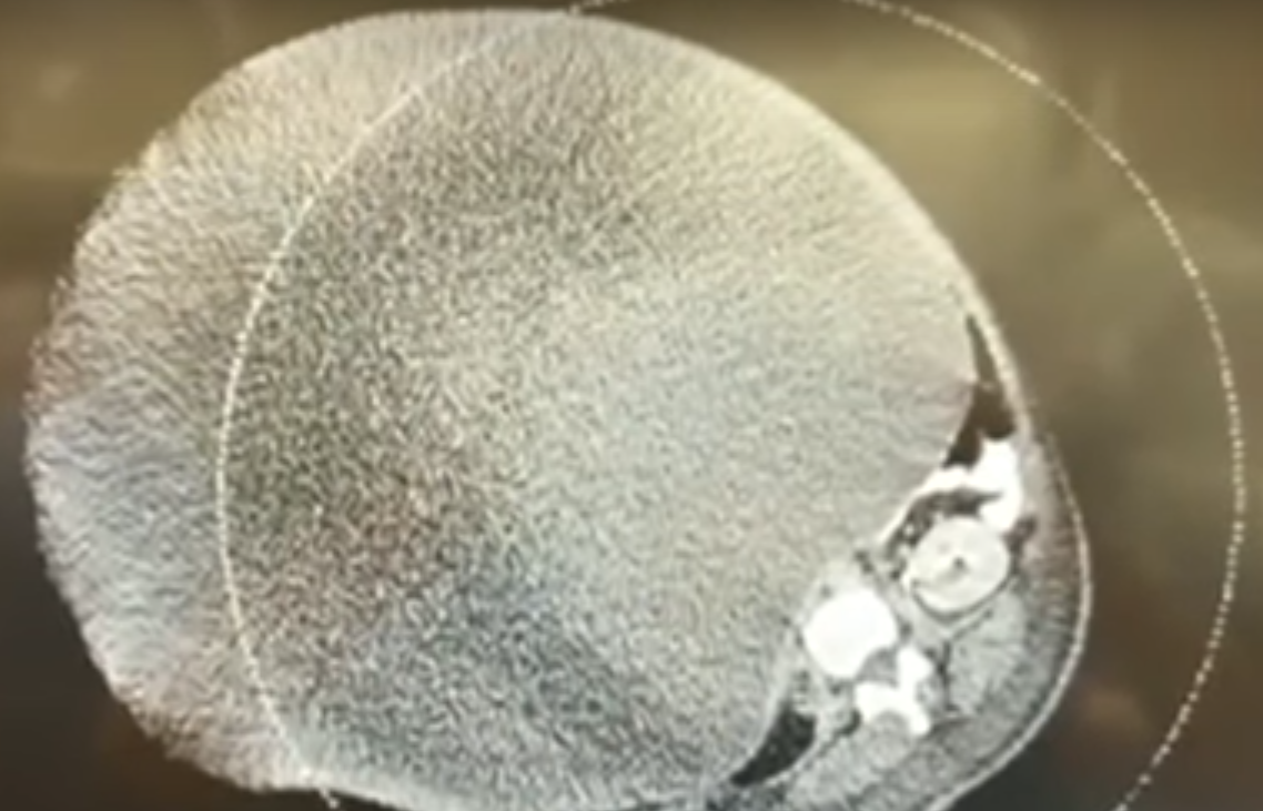 Cyst
