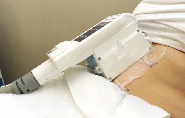 Coolsculpting Beverly Hills