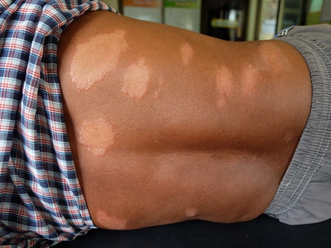 Leprosy Cases On Rise In FL, Could Be Caused By Common Animal, Experts Say