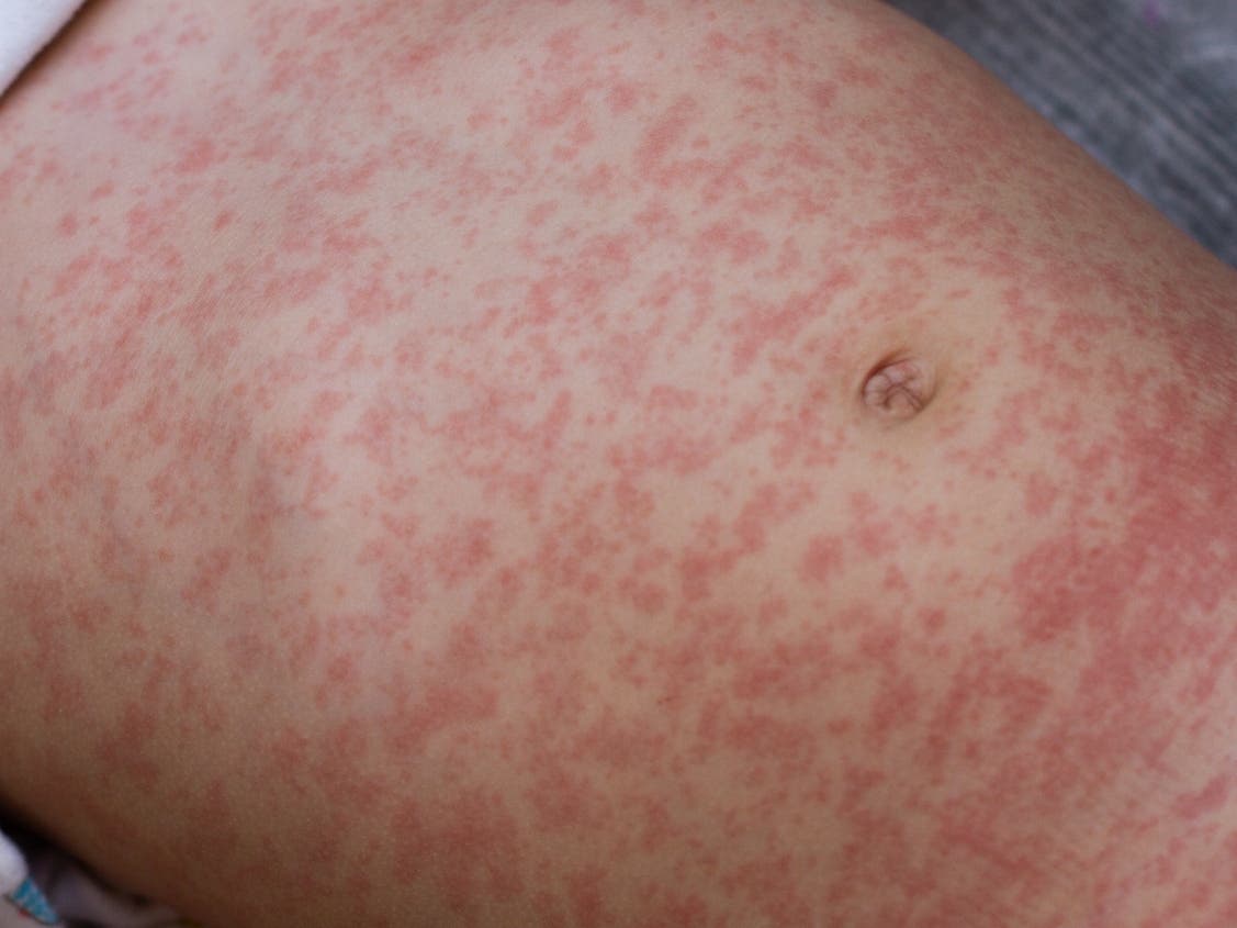 First MD Measles Case Of 2026 Confirmed In Traveler