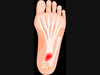 Plantar fasciitis and heel spurs can present with foot pain.