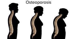 Bone and Joint Health Awareness via Zoom