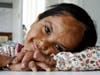 4 year old Meher after plastic surgery on her hands and face.