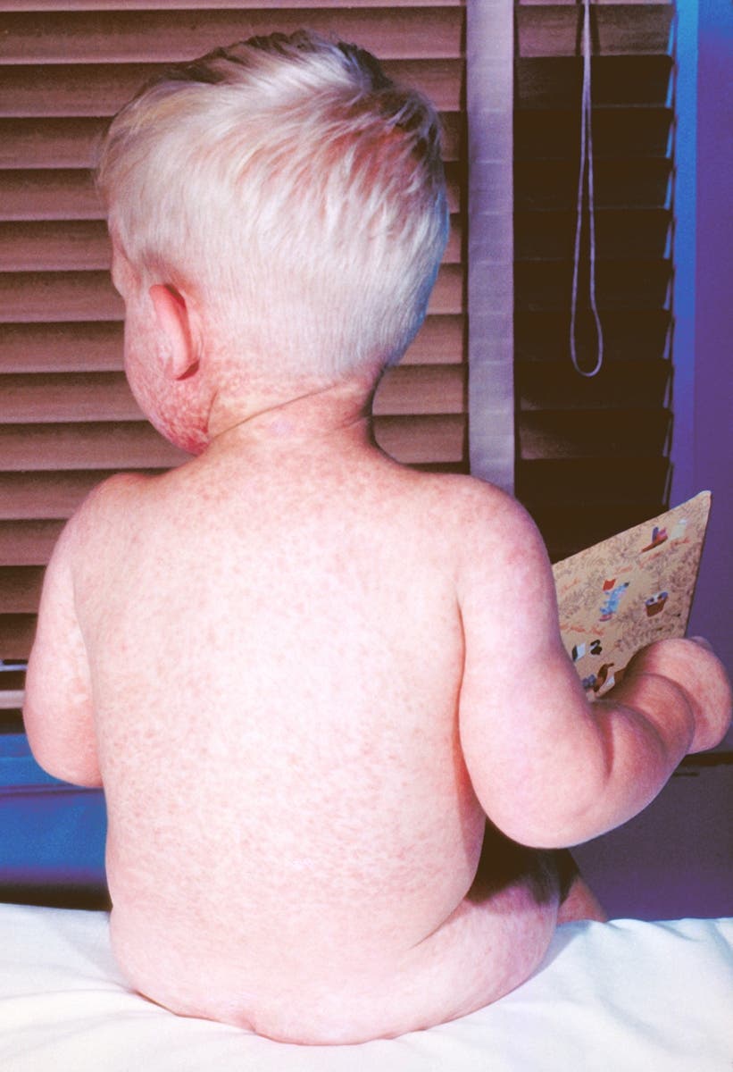 Common symptoms of measles include a rash, fever, cough, a runny nose and red eyes.