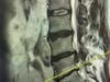 An MRI reveals both a collapsed disc (yellow line) and herniation (just above yellow line).