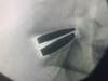 An X-ray shows the artificial disc in Dr. Barrows' spine following surgery.