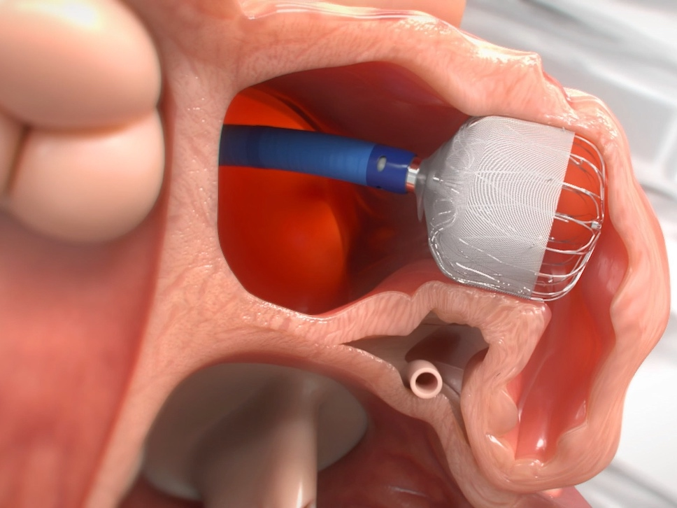 This model depicts a WATCHMAN implant inserted into a patient’s left atrial appendage (LAA) of the heart through a small incision in the inner thigh, reducing Afib patients’ stroke risk.  