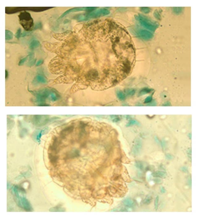 Scabies Testing 4 Scabies Tests At Lakewood Nursing Home Negative: NJDOH (Update ...