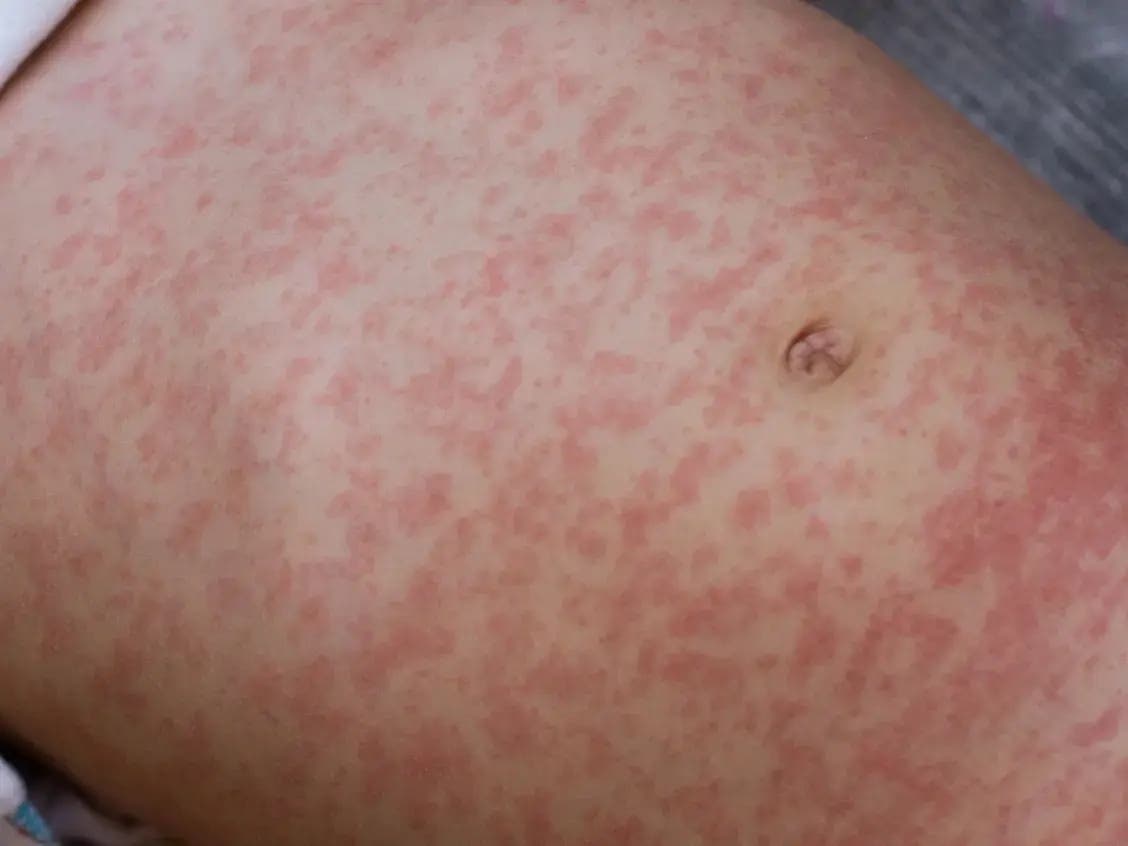 More Measles Deaths Reported In PA: Where Montgomery Co. Cases Stand