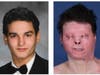 Joe DiMeo, 22, of Clark before and after the car crash that burned more than 80 percent of his body.