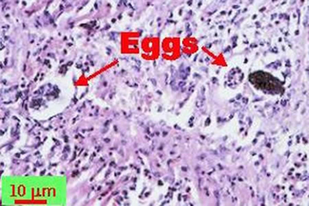 https://patch.com/img/cdn20/users/22872998/20180802/064422/styles/raw/public/processed_images/lungworm-1533249605-9987.jpg