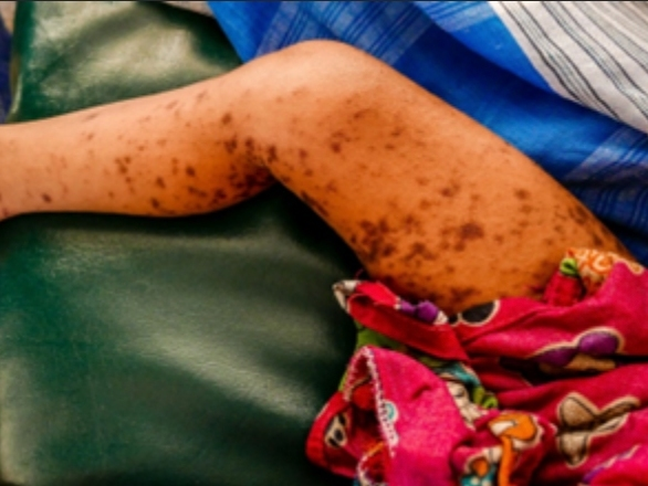https://patch.com/img/cdn20/users/22896833/20240111/011203/styles/patch_image/public/rash-on-darker-skin-4___11131119873.png