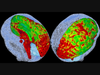After sustaining the initial hit, the cerebrospinal fluid (CSF) loses its cushioning effect with each additional back-and-forth movement of the skull. This leads to direct brain-to-skull contacts. CSF, typically modeled as blue dots, is absent here. 