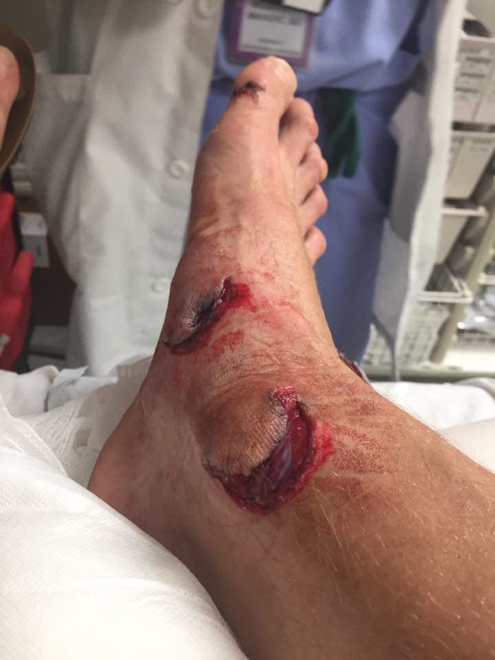 gashed foot