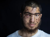 Uwais Hammam, 18, from the West Bank village of Khirbet Bani Harith, is treated at the Palestine Medical Complex, Ramallah, after being kidnapped and assaulted by settlers and soldiers, leaving him with serious injuries, 6 December. 