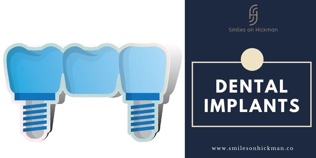 Dental Implant Treatment West Des Moines, IA Patch