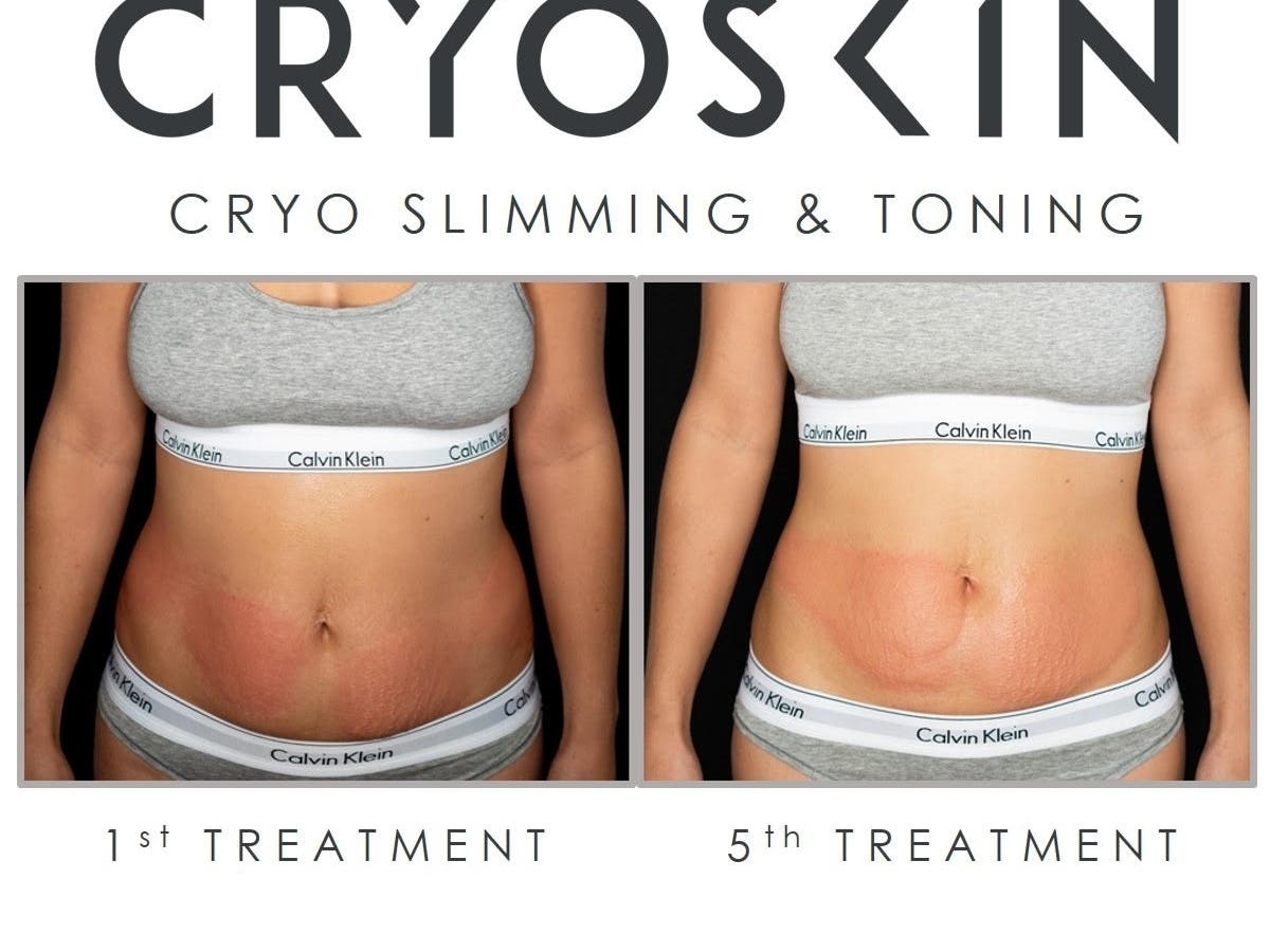 Lose Fat and Look Fab at Everett's CryoHub