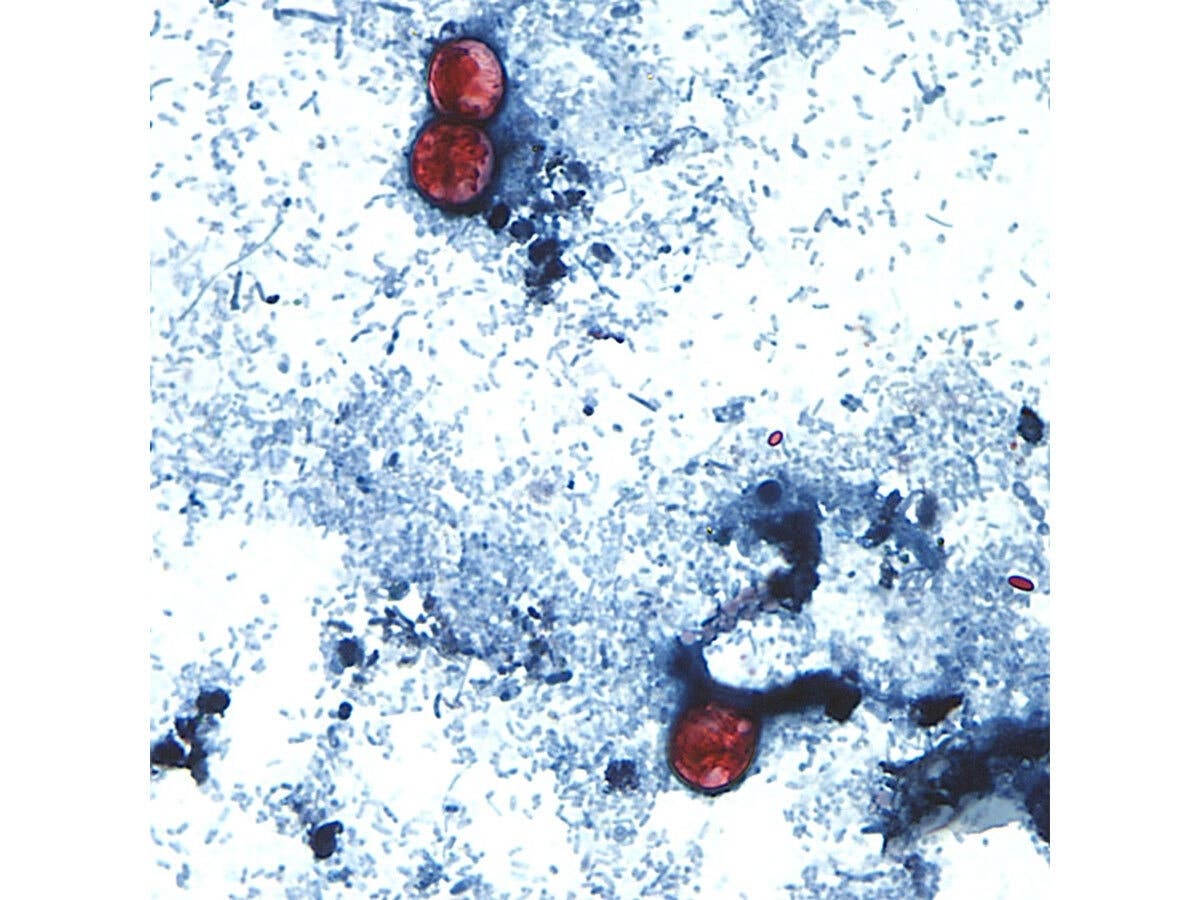 This undated photo taken through a microscope provided by the CDC shows Cyclospora cayetanensis oocysts found in a fresh stool sample which had been prepared with a formalin solution and stained with safranin