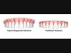 Implant-Supported Dentures vs Conventional Dentures