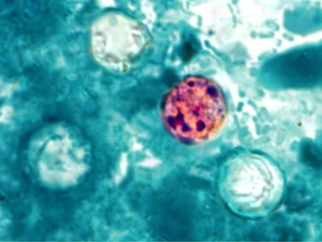The diarrhea-causing parasitic illness has been found in 72 of Michigan's 83 counties, with most in the southeastern portion of the state, according to state data.