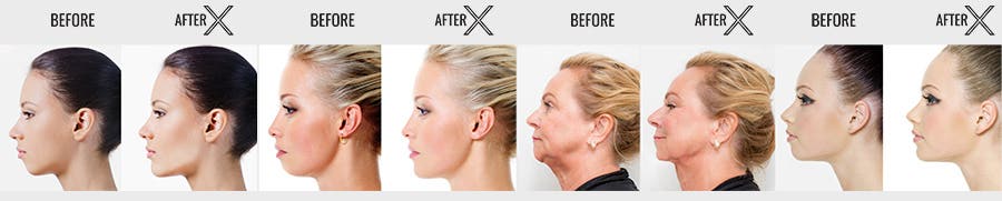 Botox Training New York