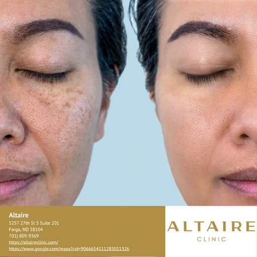 Altaire Clinic in Fargo Offers Provider-Led Skin Pigmentation Treatment