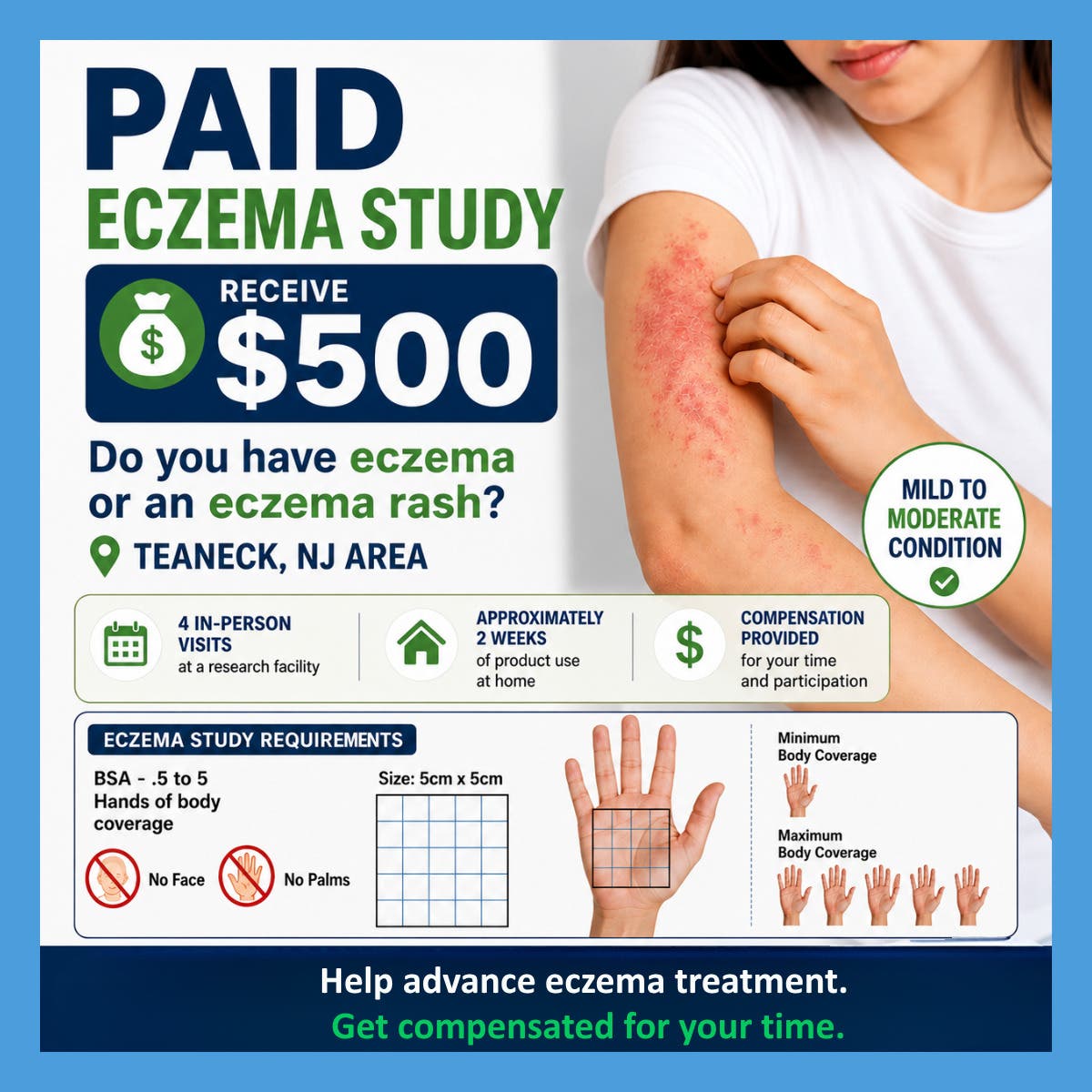  	$500 Paid Eczema Research Study