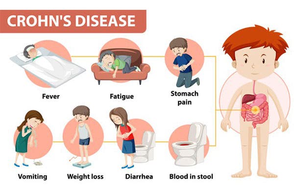 Crohn's Disease: Causes, Symptoms, Western and Holistic Treatments - Philadelphia, PA Patch