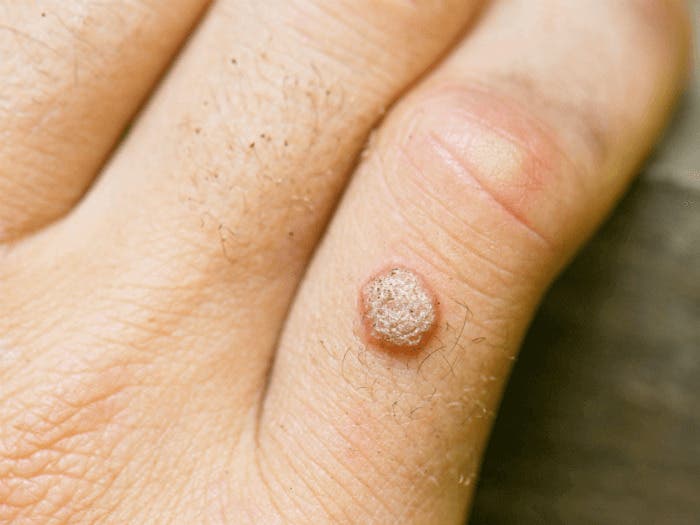Warts: Nature, Causes, Symptoms, and Holistic Treatments