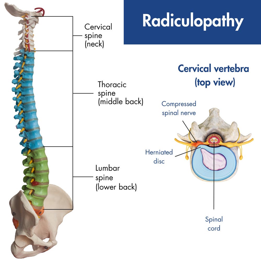 Radiculopathy: Causes, Symptoms, Diagnosis, and Acupuncture Treatment