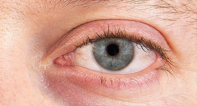 Dry eyes