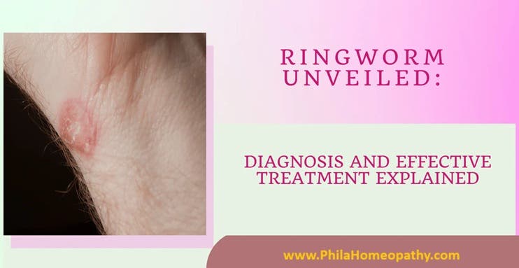 Ringworm Disease: Causes, Symptoms, Western and Holistic Treatments