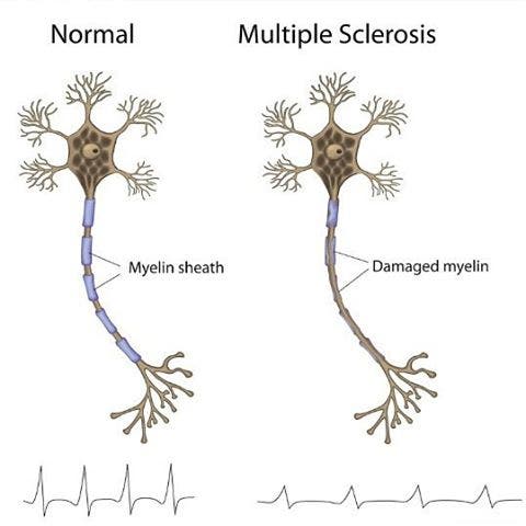 Multiple Sclerosis aka MS: Homeopathic and Acupuncture Treatment