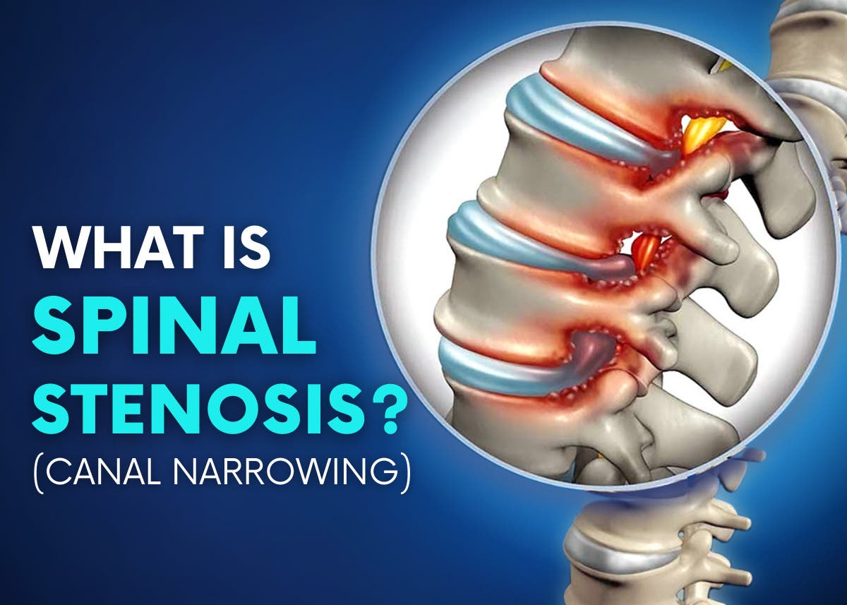 Spinal Stenosis: Causes, Symptoms, Conventional and Holistic Treatments