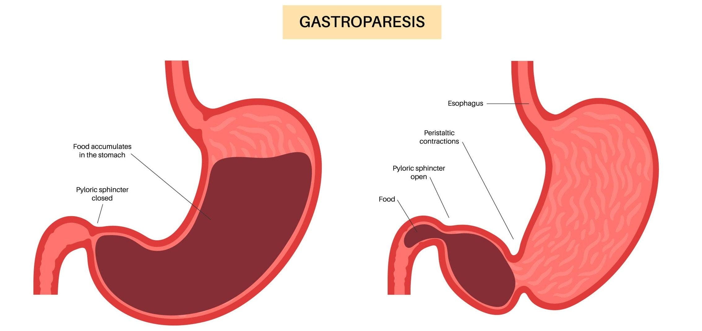 Holistic Treatment for Gastroparesis