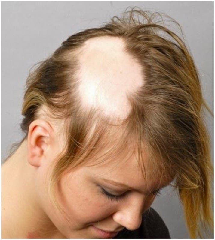 Natural Treatment for Alopecia Areata