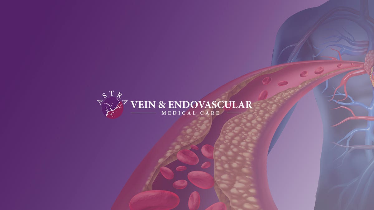 Astra Vein Treatment Center
